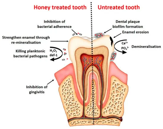 Foods | Free Full-Text | Antibacterial and Antibiofilm Effect of Honey in the Prevention of Dental Caries: A Recent Perspective