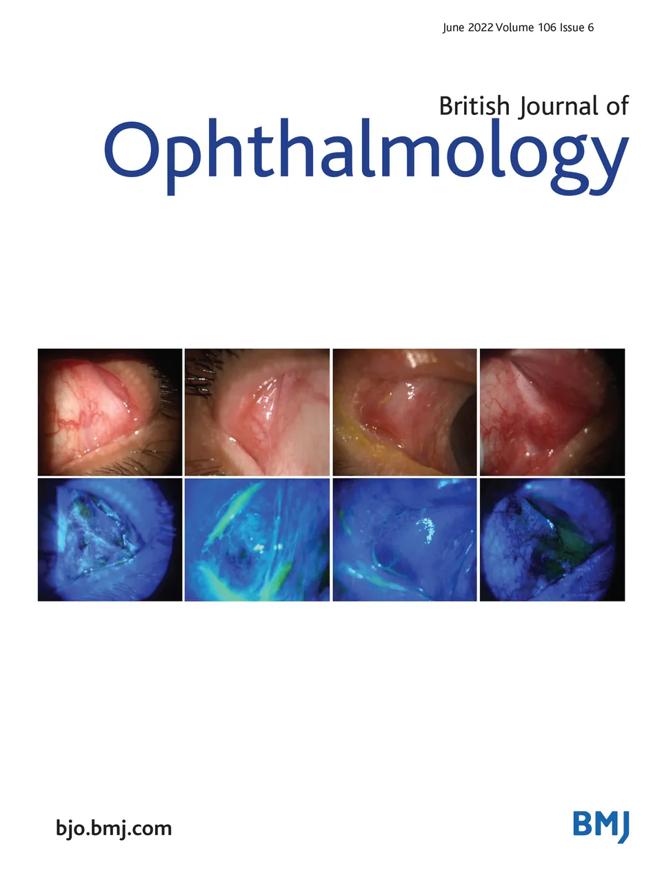 Randomised assessor-masked trial evaluating topical manuka honey (Optimel) in treatment of meibomian gland dysfunction | British Journal of Ophthalmology