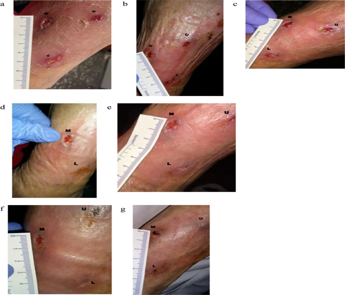 Journal of Wound Ostomy & Continence Nursing